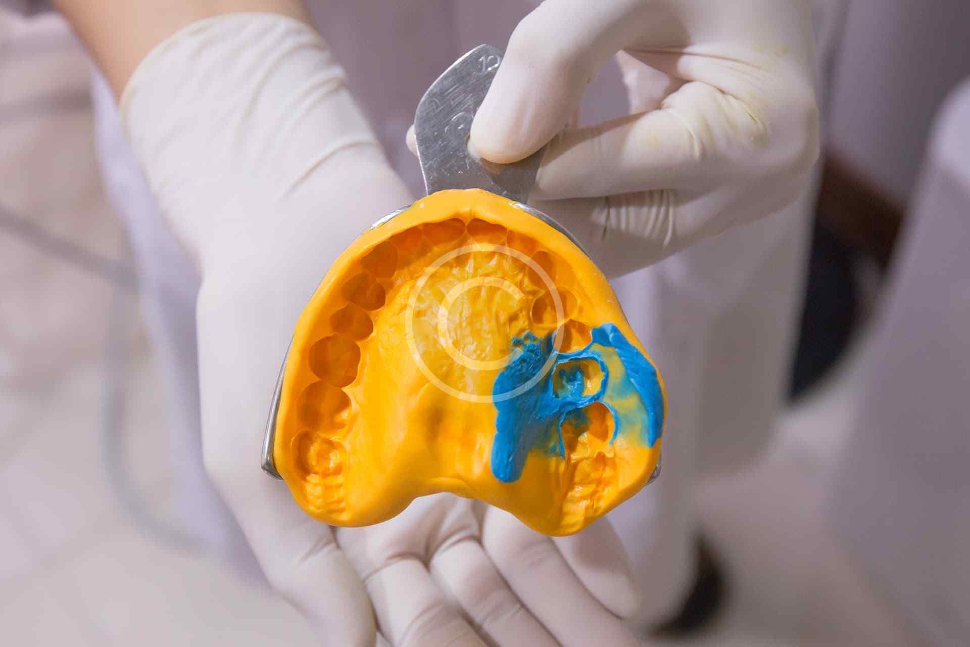 הלבנת שיניים מרפאתית